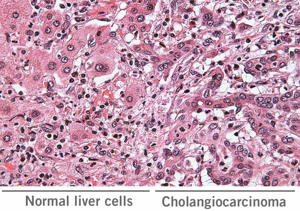 Figure: Difference normal liver cells and cholangiocarcinoma (CCA)