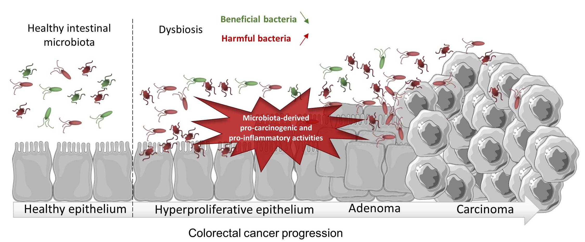 Colorectal cancer - progression of colon bacteria