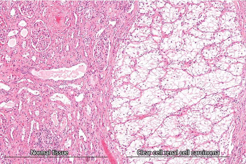 Normal tissue vs Clear cell renal cell carcinoma
