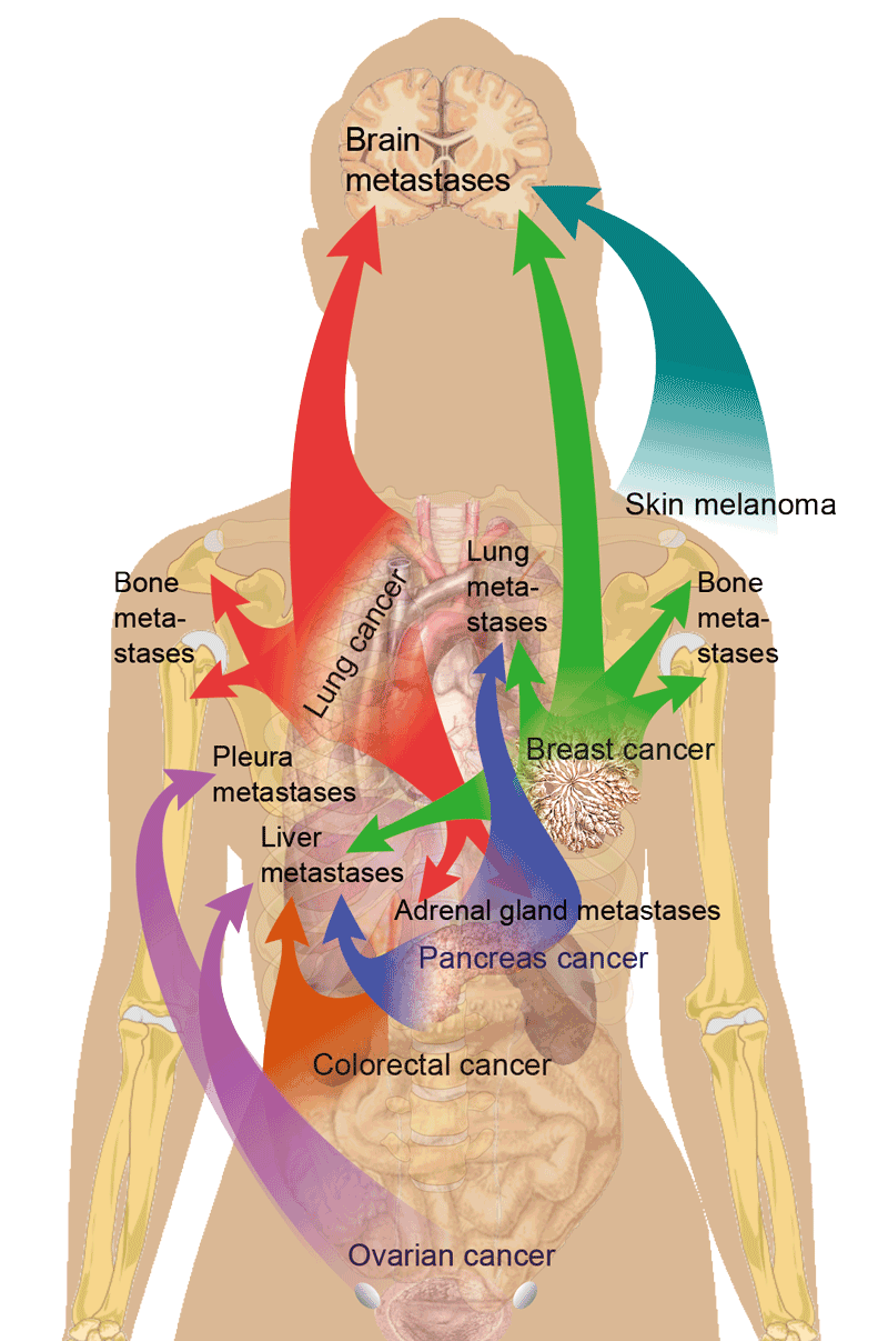 The most usual places of metastasis for different types of cancer
